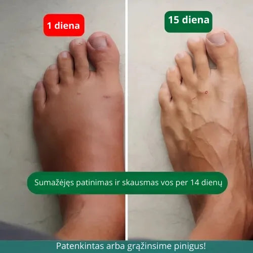 Zenstride® Kvėpuojančios kompresinės kojinės be skausmo kojoms ir pėdoms