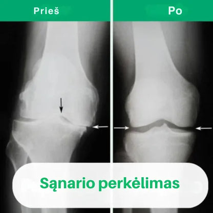 OrthoKnee™ – Ilgalaikis palengvėjimas nuo artrito ir sąnarių skausmų